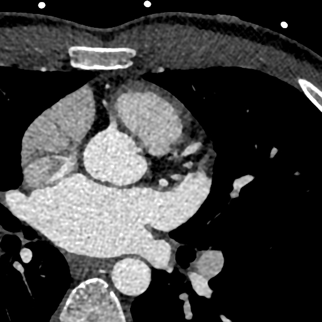 Cardiac Ct Radiology Reference Article Radiopaedia Org