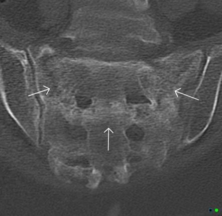 Sacral Insufficency Fractures Radiology Case Radiopaedia Org