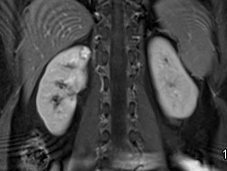 Renal Cell Carcinoma Tnm Staging Radiology Reference Article