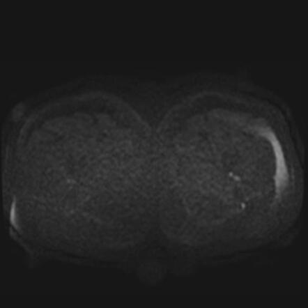 Testicular Seminoma Image Radiopaedia Org