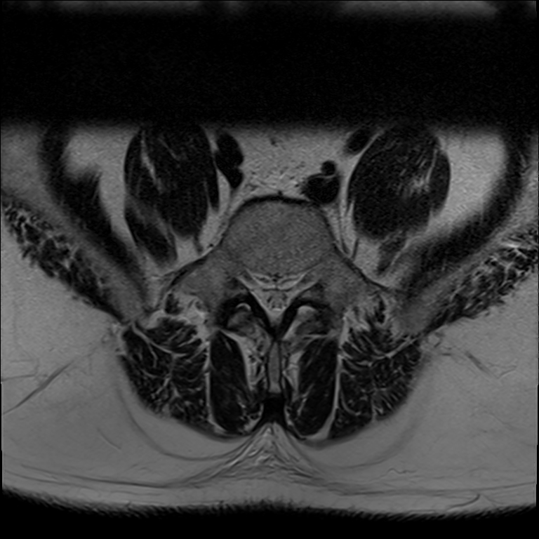 Bilateral Hip Avascular Necrosis Image Radiopaedia Org