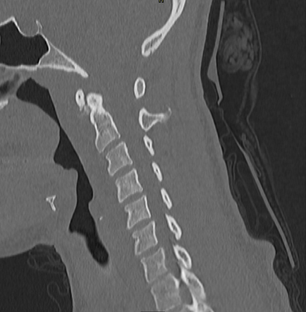 Calcific Tendinitis Of The Longus Colli A Sagittal Ct Showing Hot Sex Picture