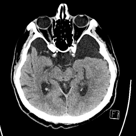 Bilateral Arachnoid Cysts Radiology Case Radiopaedia Org