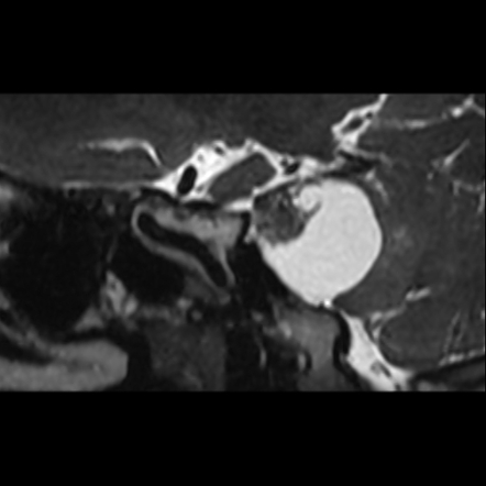 Trigeminal Cystic Schwannoma Image Radiopaedia Org