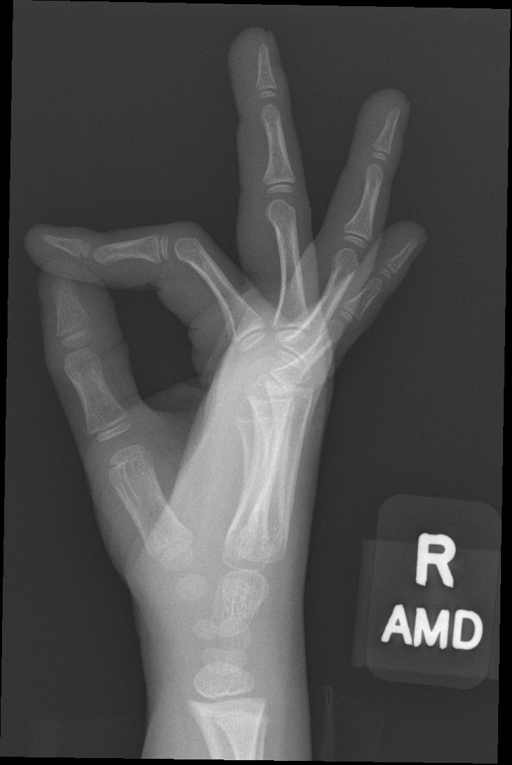 Normal Hand Radiographs Pediatric Image Radiopaedia Org