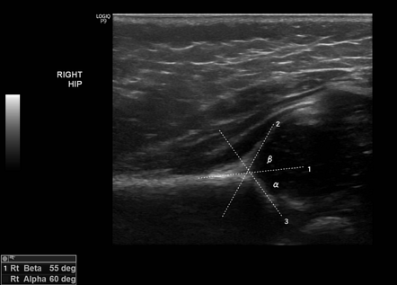 Graf Method For Ultrasound Classification Of Developmental Dysplasia Of