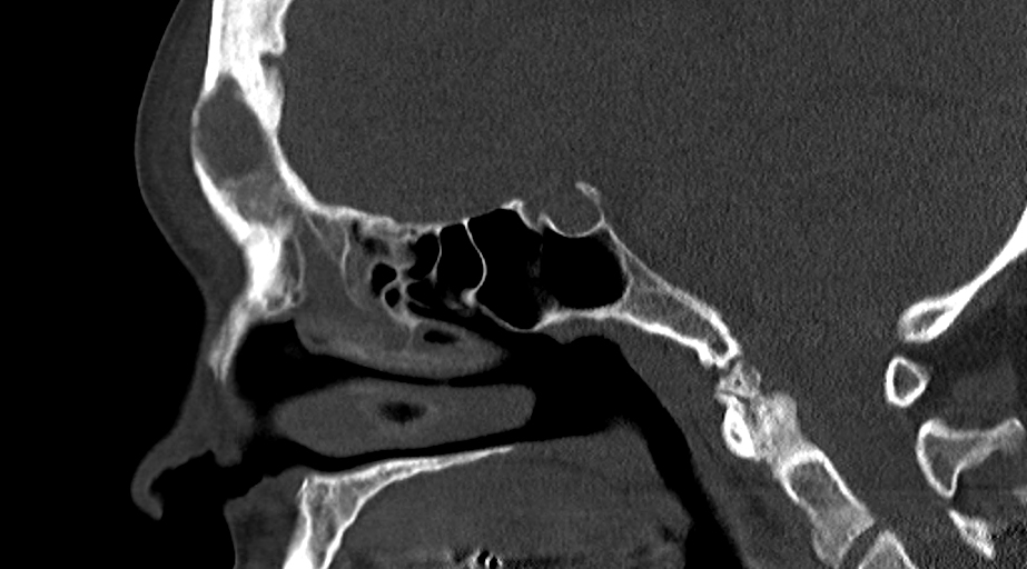 Pott Puffy Tumor Image Radiopaedia Org