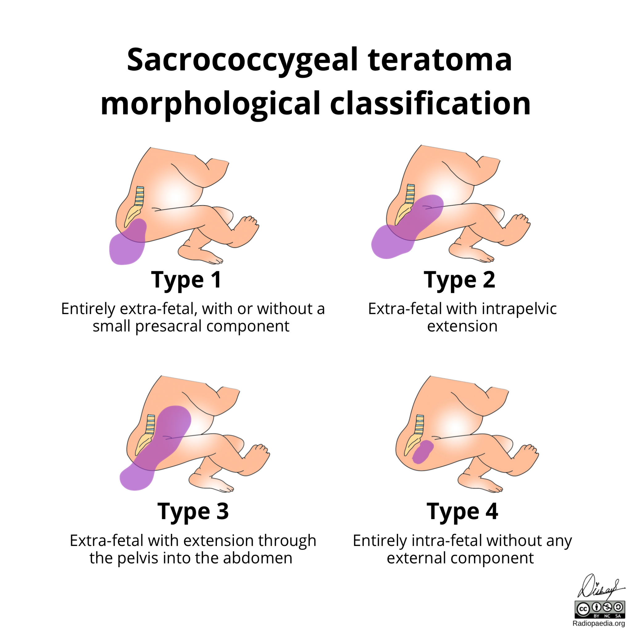 Morphological Classification Of Sacrococcygeal Teratomas Image