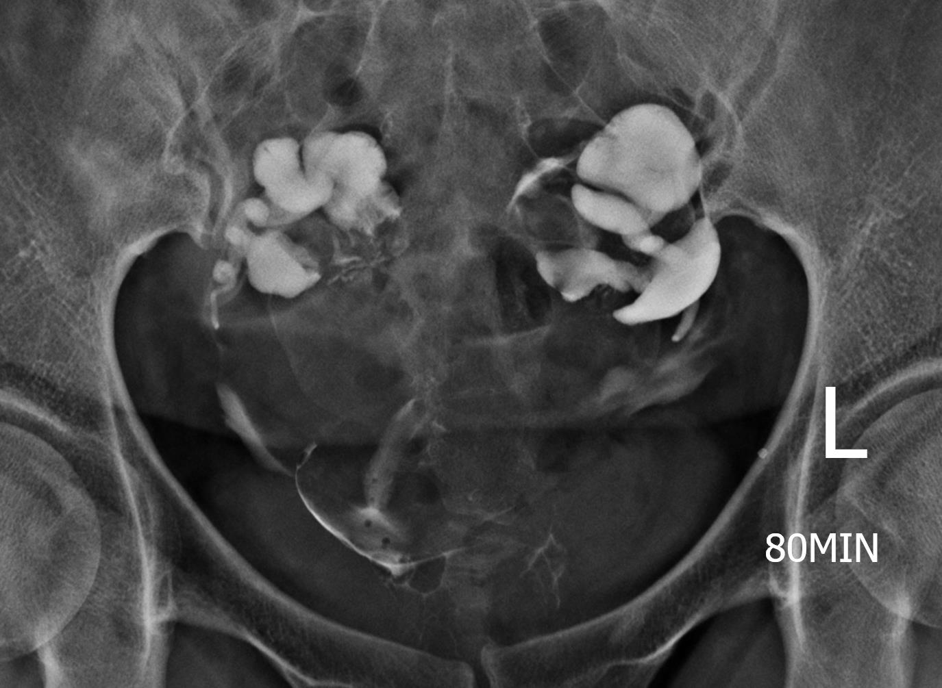 Bilateral Tubal Block And Hydrosalpinx Image Radiopaedia Org