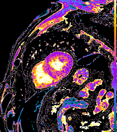 Cardiac Amyloidosis Radiology Reference Article Radiopaedia Org