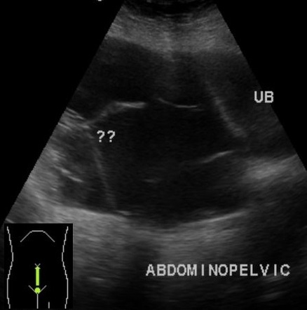 Ovarian Seromucinous Borderline Tumor SMBT And Serous Cystadenoma