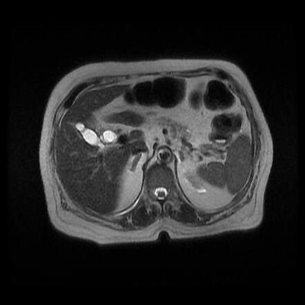 Choledocholithiasis And Cholelithiasis Mrcp Radiology Case