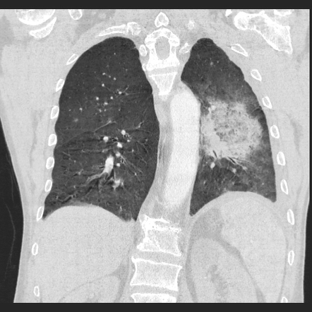 Pulmonary Scedosporium And Lomentosa Infections Radiology Reference