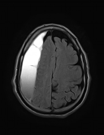 Subacute Subdural Hematoma Radiology Case Radiopaedia Org