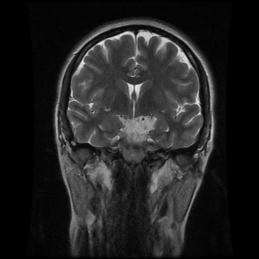 Intracranial Epidermoid Cyst Image Radiopaedia Org