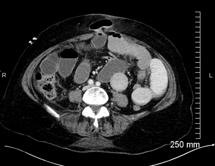 Port Site Hernia Radiology Reference Article Radiopaedia Org