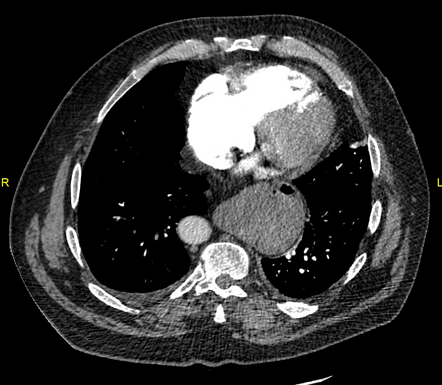 Pulmonary Embolism With Right Heart Strain Radiology Case