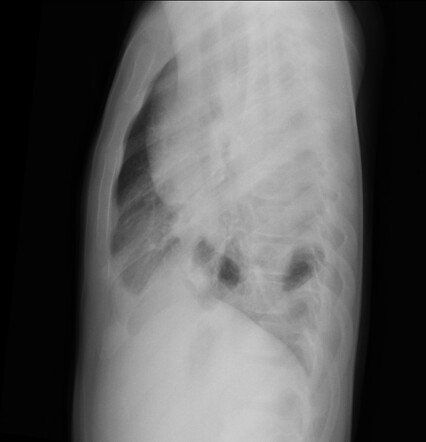 Ewing Sarcoma Of The Rib Radiology Case Radiopaedia Org