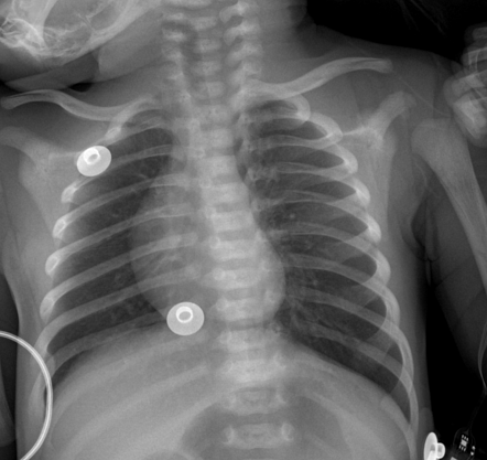 Normal Chest Radiograph Neonate Radiology Case Radiopaedia Org