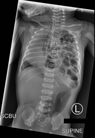 Congenital Diaphragmatic Hernia Radiology Case Radiopaedia Org