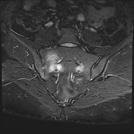 Sacral Insufficiency Fracture Radiology Case Radiopaedia Org