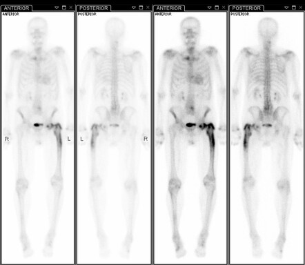 Paget Disease Radiology Case Radiopaedia Org