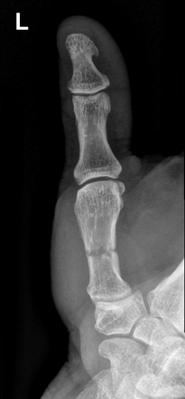 Metacarpal Fracture Radiology Reference Article Radiopaedia Org