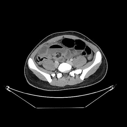 Perforated Meckel S Diverticulitis Radiology Case Radiopaedia Org