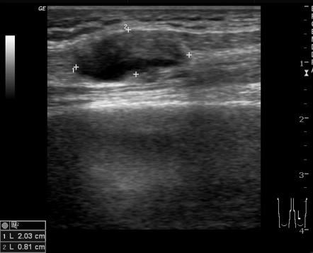 Quadriceps Tendon Cyst Radiology Case Radiopaedia Org