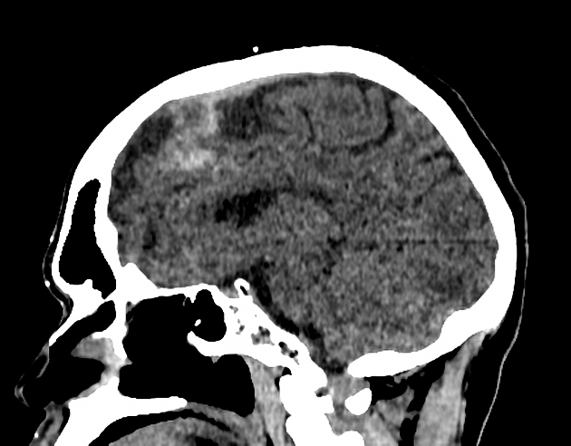 Subarachnoid Haemorrhage Radiology Reference Article Radiopaedia Org