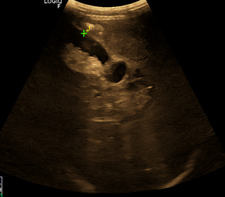 Gallbladder Sludge Radiology Case Radiopaedia Org