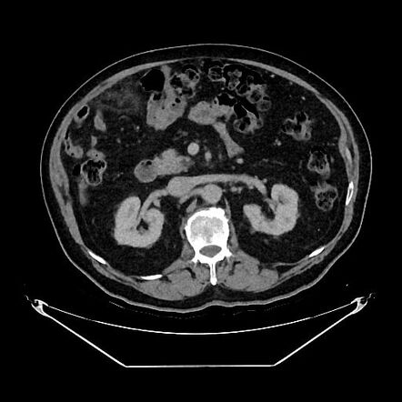 Epiploic Appendagitis Radiology Case Radiopaedia Org