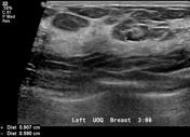 Intramammary Lymph Nodes Radiology Reference Article Radiopaedia Org