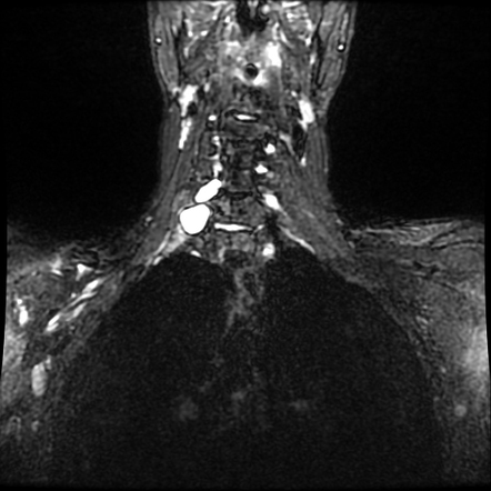 Traumatic Brachial Plexus Injury With Pseudomeningoceles Radiology