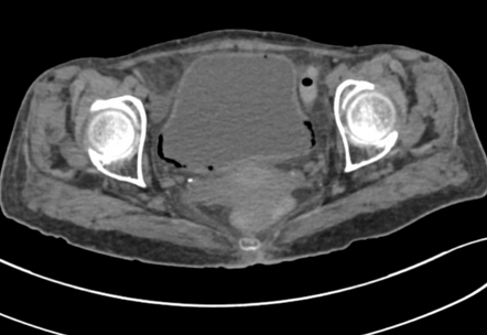 Emphysematous Cystitis With Pyelitis Radiology Case Radiopaedia Org