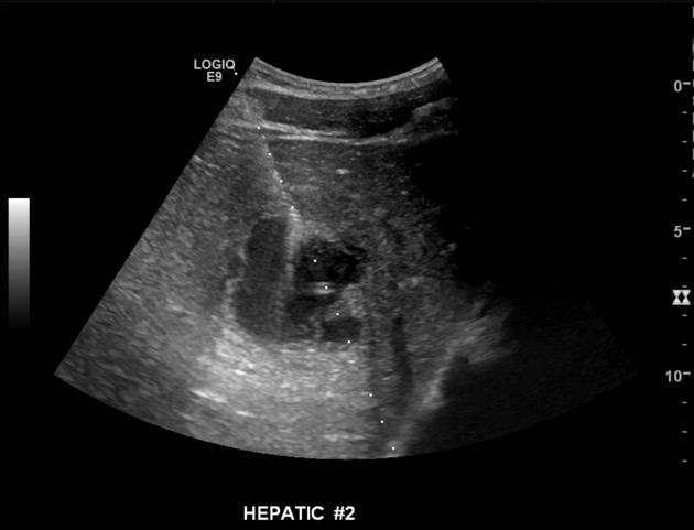 Hepatic Abscess Radiology Reference Article Radiopaedia Org