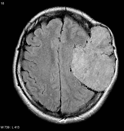 Solitary Fibrous Tumor Hemangiopericytoma Image Radiopaedia Org