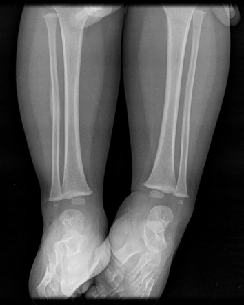 Paediatric Fracture Of Fibula Radiology Case Radiopaedia Org