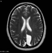 Arachnoid Cyst Radiology Reference Article Radiopaedia Org