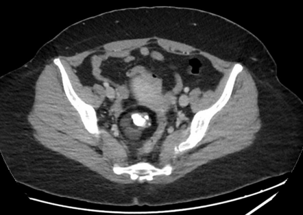 Mature Cystic Ovarian Teratoma Radiology Case Radiopaedia Org