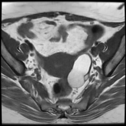 Mature Cystic Ovarian Teratoma Radiology Case Radiopaedia Org