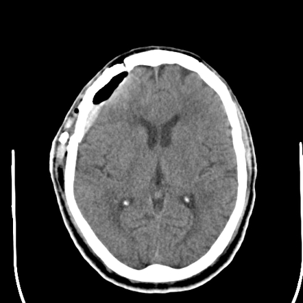 Subdural Haematoma Radiology Case Radiopaedia Org