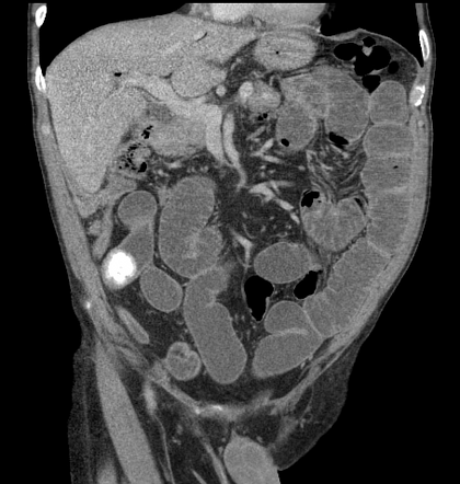 Gallstone Ileus Radiology Case Radiopaedia Org