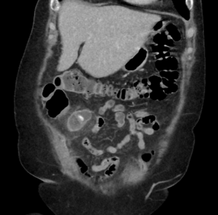 Meckel Diverticulitis Radiology Case Radiopaedia Org