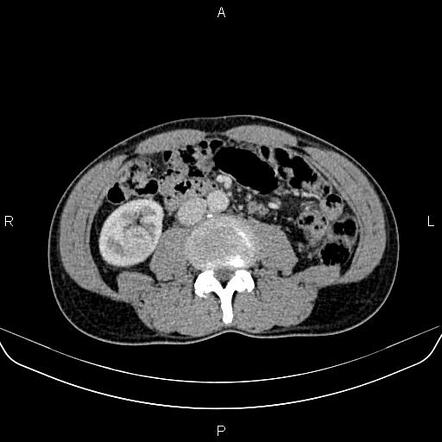 Renal Cell Carcinoma Tnm Staging Radiology Reference Article