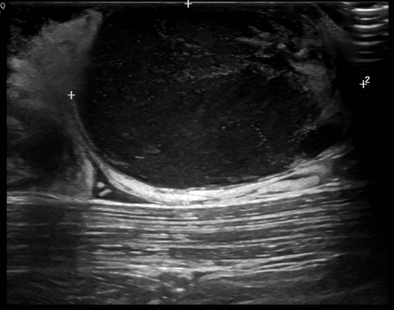 Dermatofibrosarcoma Protuberans With Fibrosarcomatous Transformation