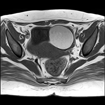 Ovarian Endometrioma With Deep Infiltration Radiology Case