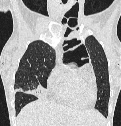 Esophagogastrectomy And Colonic Interposition Radiology Case