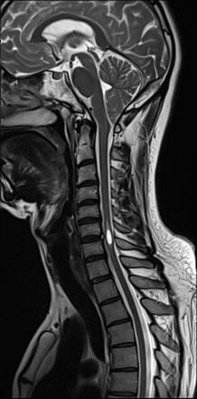 Chiari Malformation With Syrinx Radiology Case Radiopaedia Org