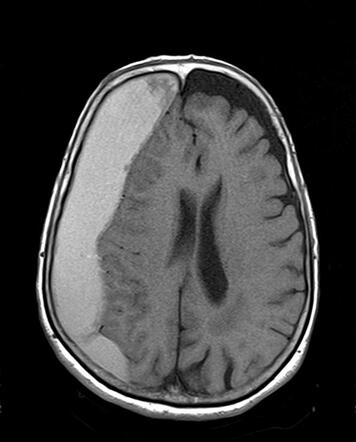 Subacute Subdural Haematoma Radiology Case Radiopaedia Org